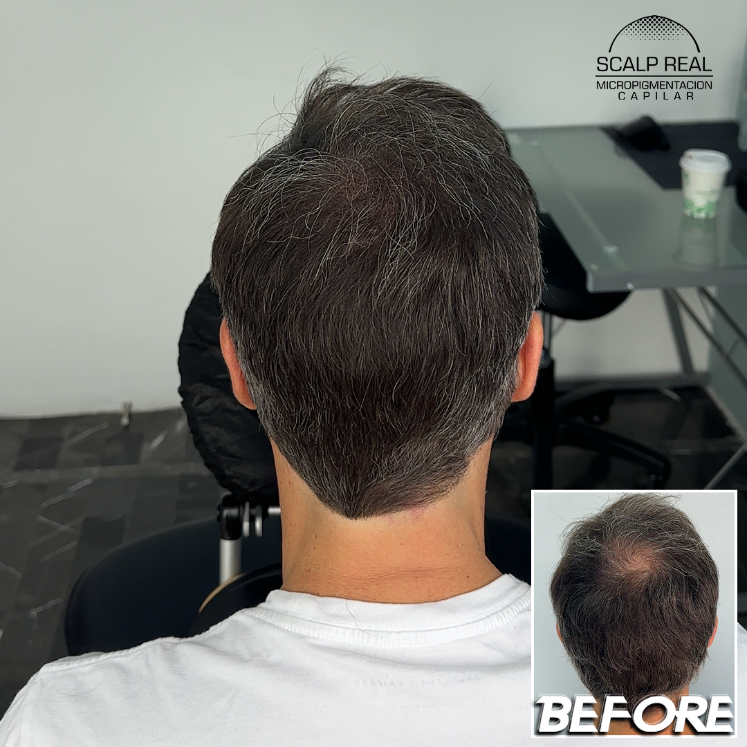 scalp micropigmentation density effect