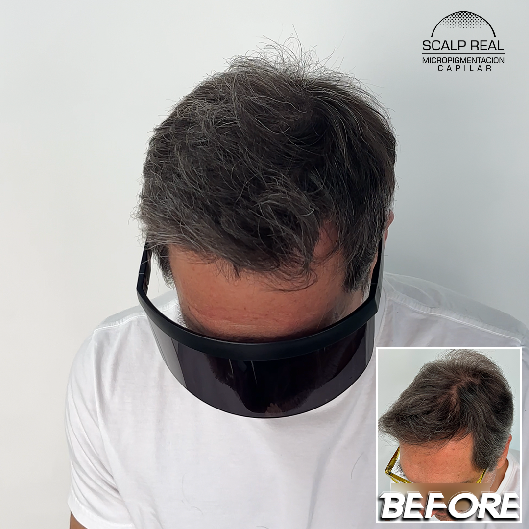 scalp micropigmentation density effect