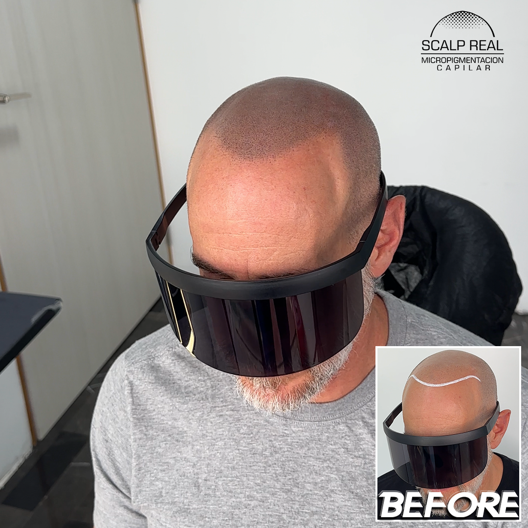 scalp micropigmentation mexico city