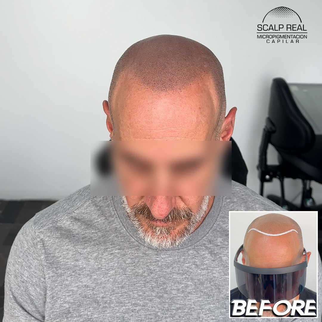 scalp micropigmentation mexico city
